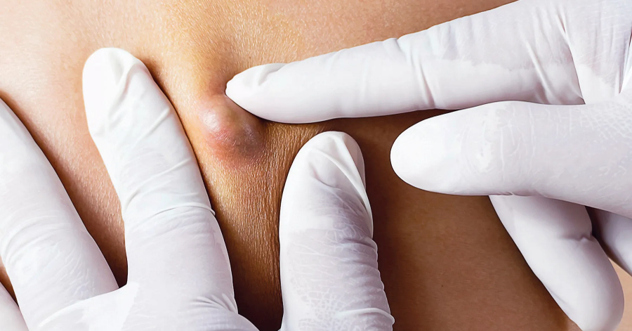 Fístulas con terapia láser