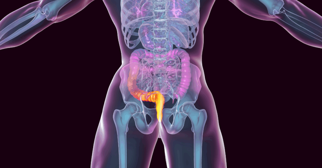 hombre con fístula anal sin tratamiento