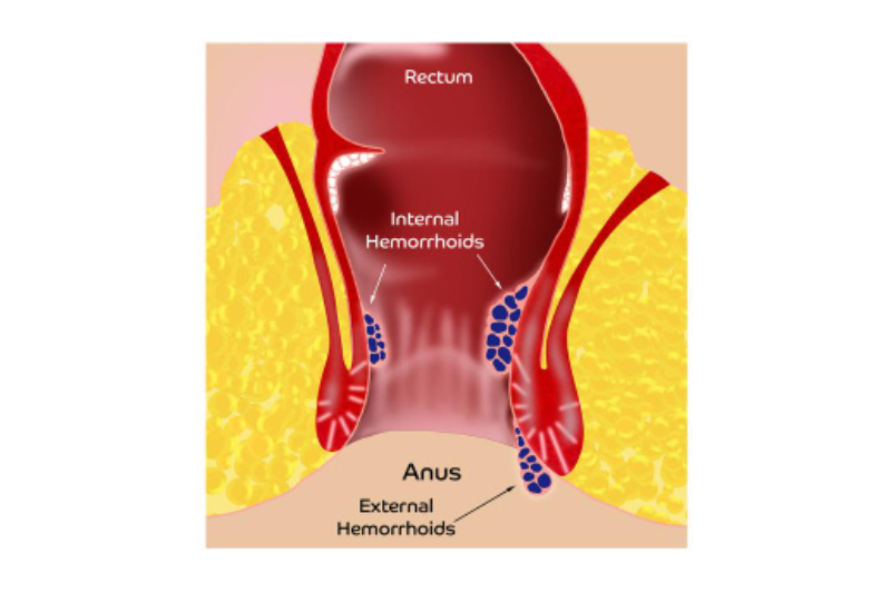Hemorrhoids Anal Skin Tags