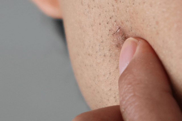 Ingrown Hairs causes pilonidal cysts