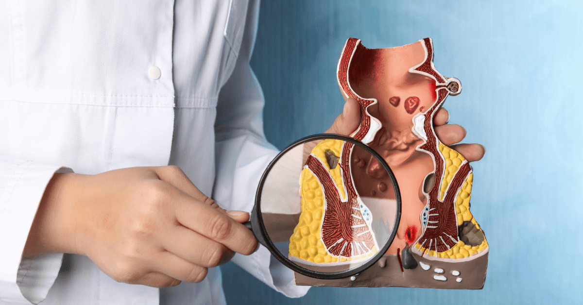 Fistula Like a Hemorrhoid?