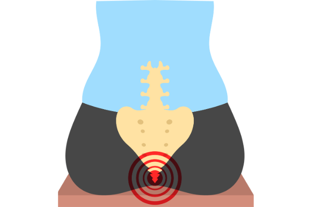 Symptoms of Pilonidal Cysts: Near the Tailbone