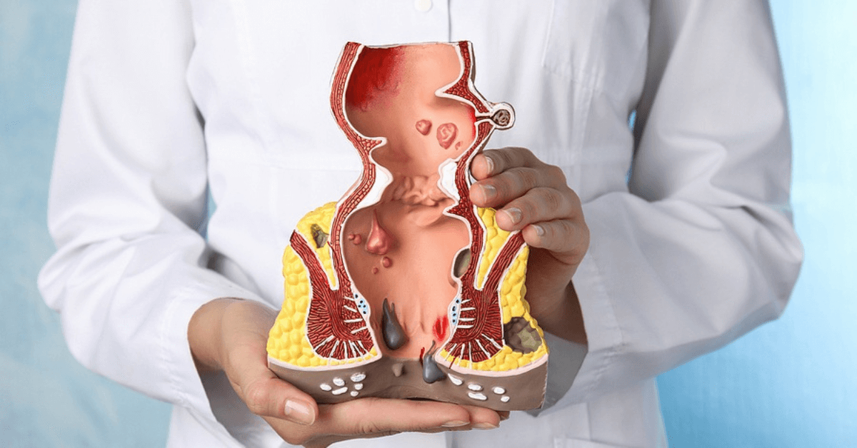 External Hemorrhoids
