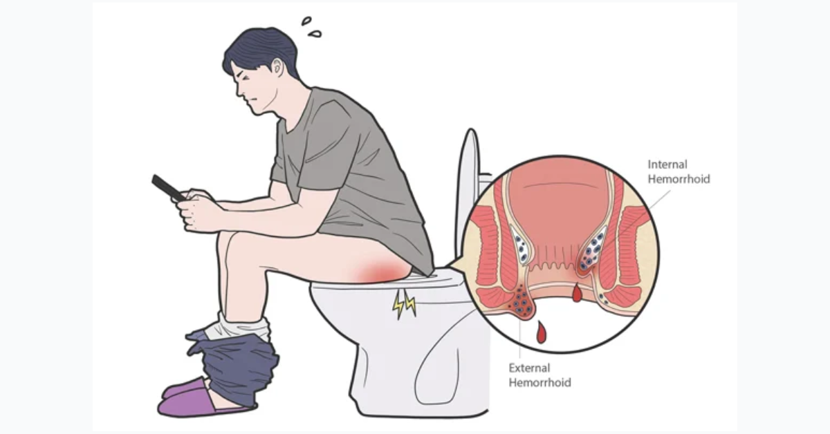 Internal vs External Hemorrhoids