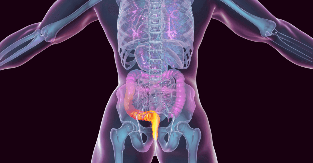 How to Shrink Hemorrhoids